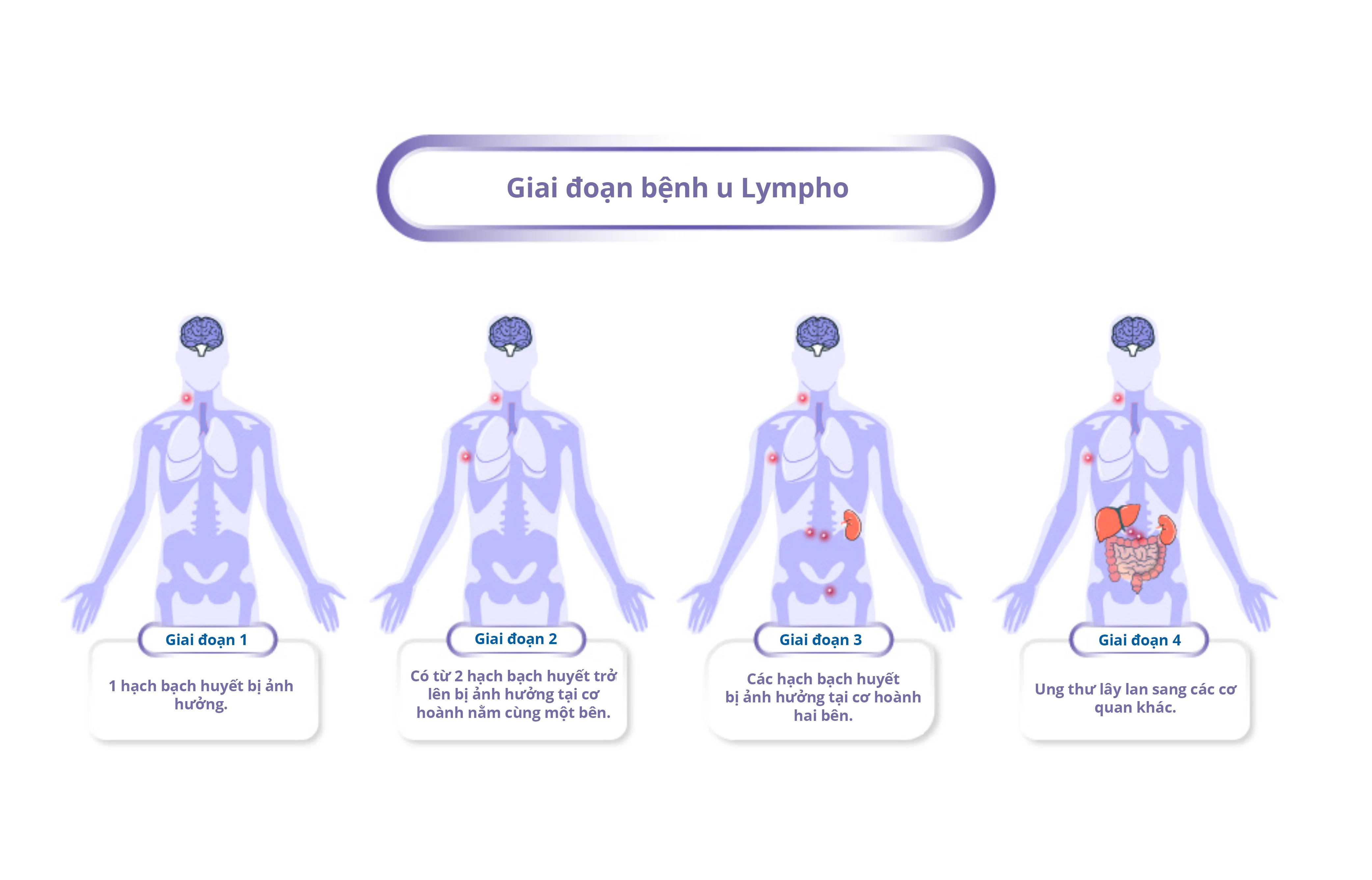 Giai đoạn ung thư hạch