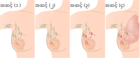 ရင်သားကင်ဆာအဆင့်များ ရင်သားကင်ဆာအဆင့်များ