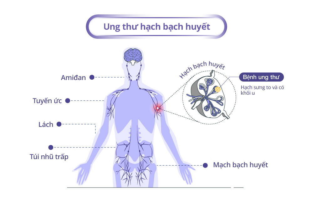 giải phẫu bệnh ung thư hạch bạch huyết