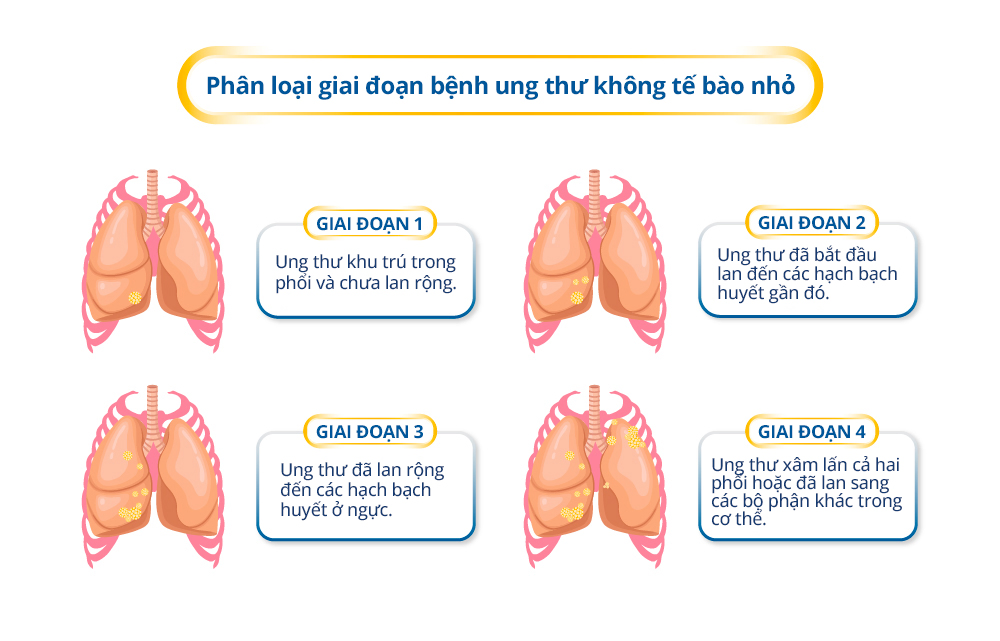 Stages of Non–Small Cell Lung Cancer