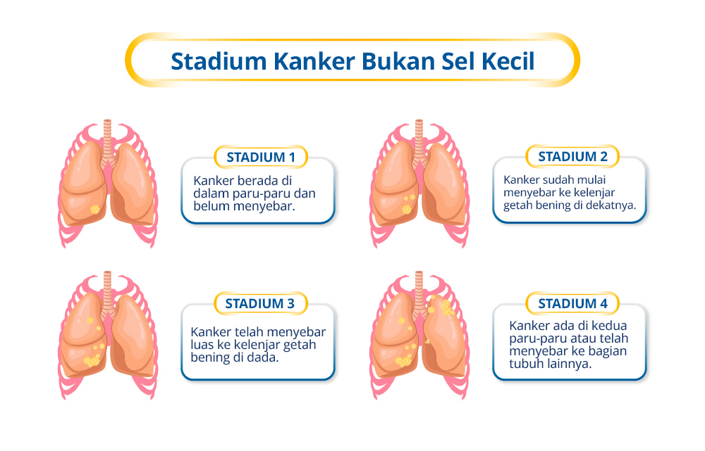Stages of Non–Small Cell Lung Cancer