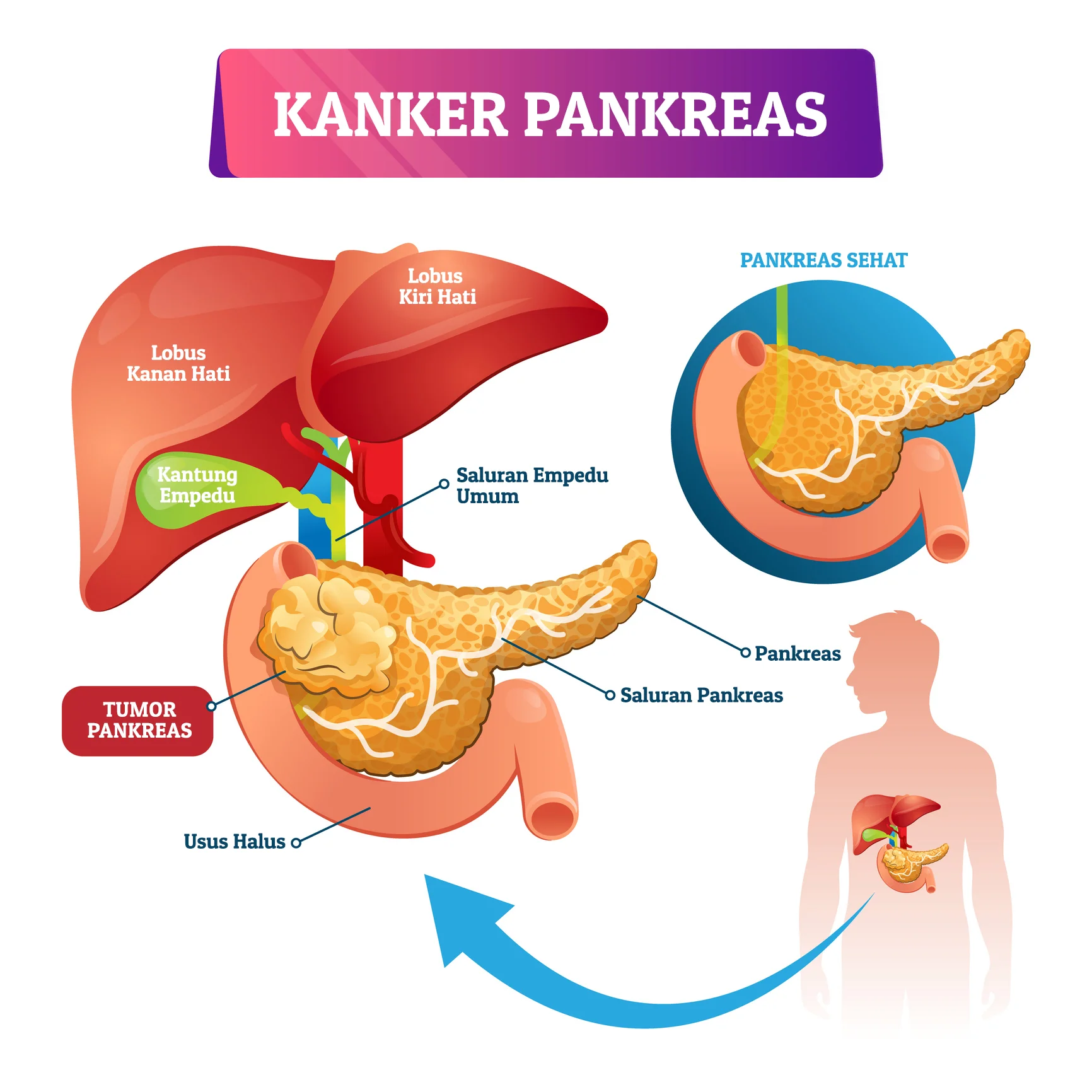 infografis kanker pankreas