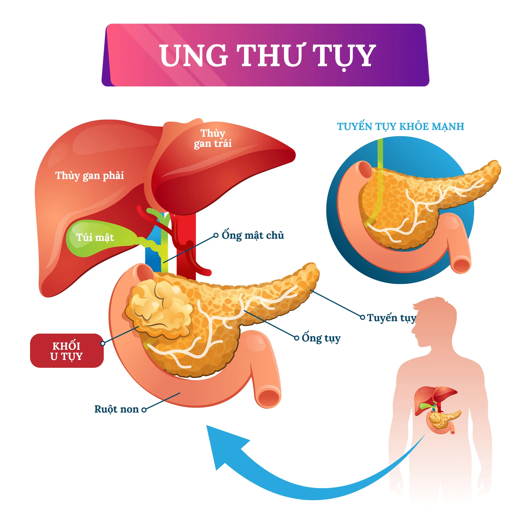 đồ họa thông tin về ung thư tuyến tụy