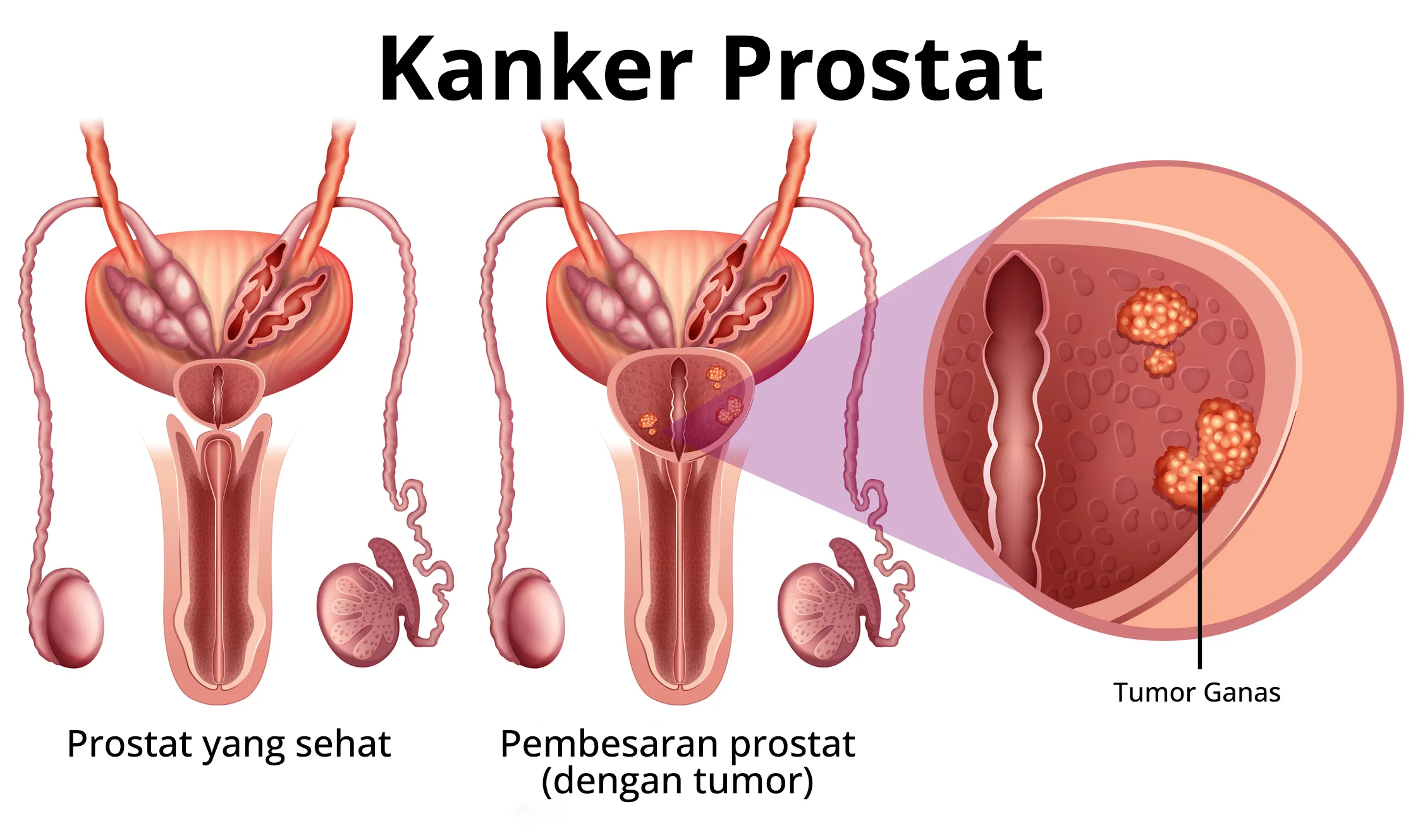 infografis kanker prostat