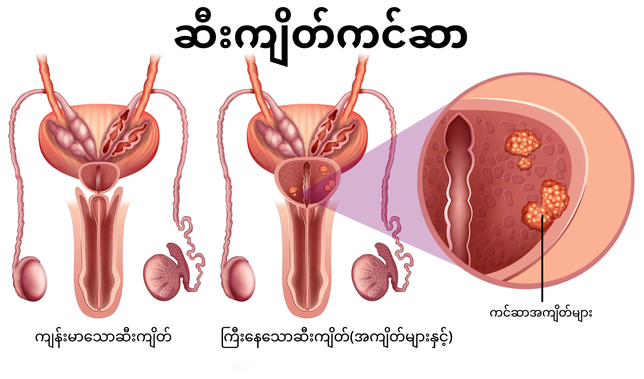 ဆီးကျိတ်ကင်ဆာ infographic