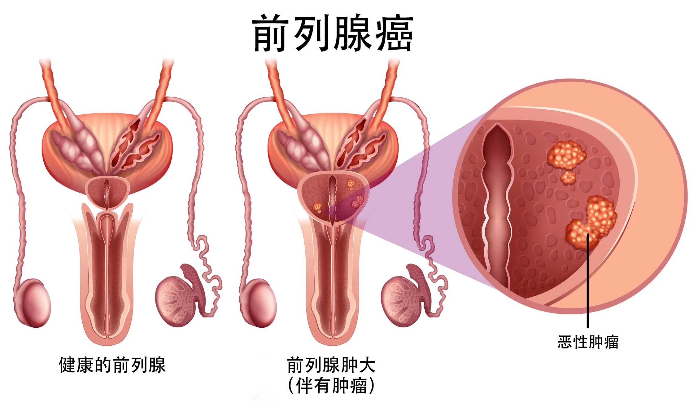 前列腺癌信息图表
