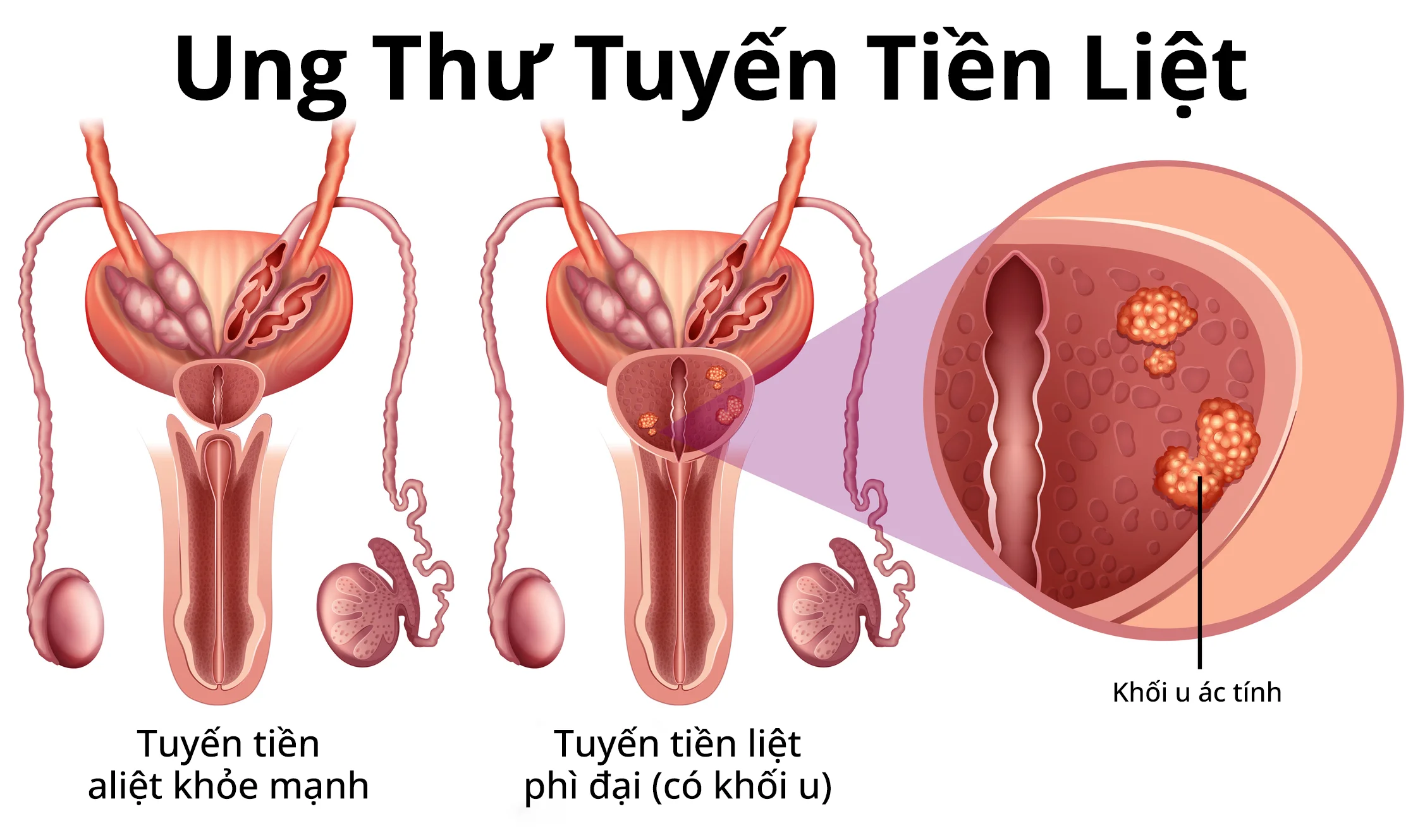 đồ họa thông tin về ung thư tuyến tiền liệt
