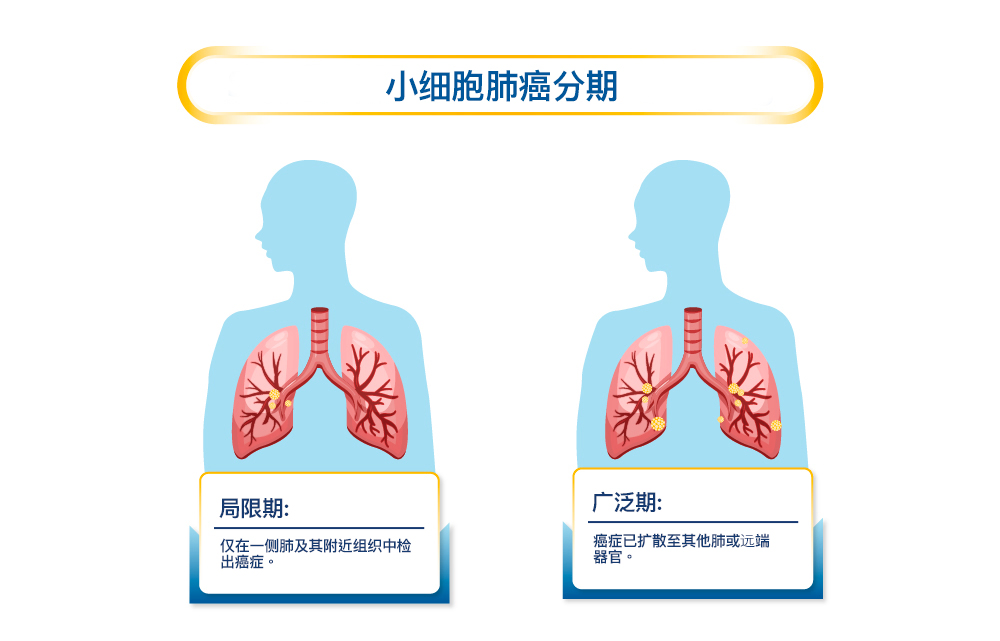 Stages of Small Cell Lung Cancer