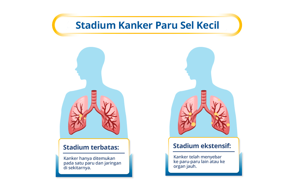 Stages of Small Cell Lung Cancer