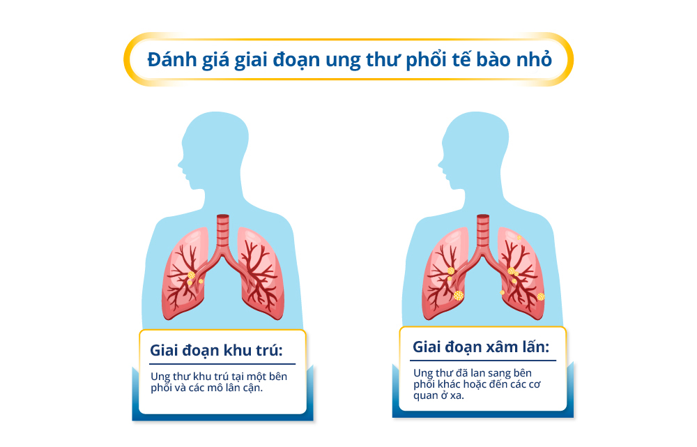 Stages of Small Cell Lung Cancer
